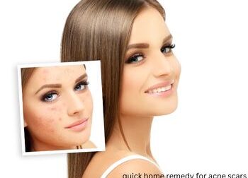 quick-home-remedy-for-acne-scars